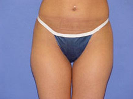 Body Contouring in Beverly Hills, CA