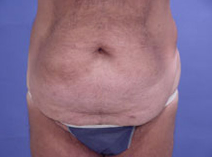 Which Type of Tummy Tuck is Right for You? - Dr. Hess