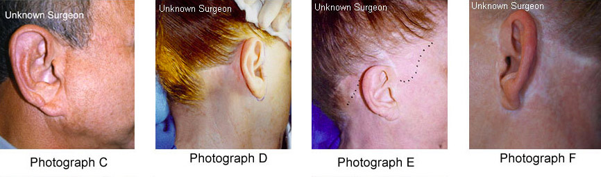 ear surgery scar